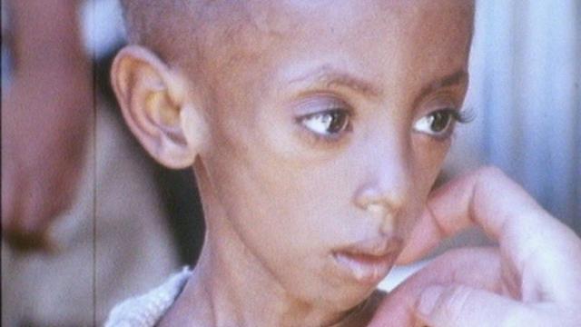 Enfant souffrant de malnutrition en Ethiopie en 1973. [RTS]