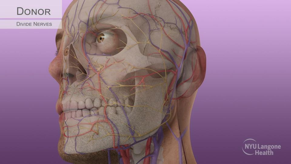 Transplantation d'une partie du visage et de l'œil gauche