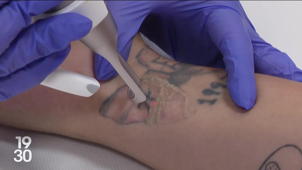 Le "détatouage", une pratique en plein essor pour celles et ceux qui souhaitent effacer leurs tatouages