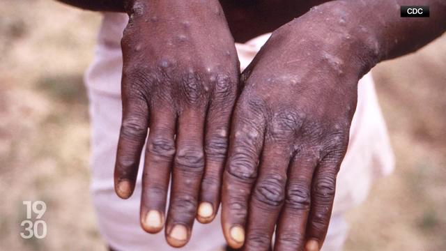 L'OMS en alerte: Le virus Mpox, aussi appelé variole du singe, se répand rapidement sur le continent africain