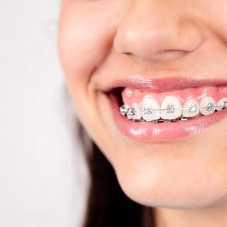 Les soins orthodontiques. [Depositphotos - Asife]